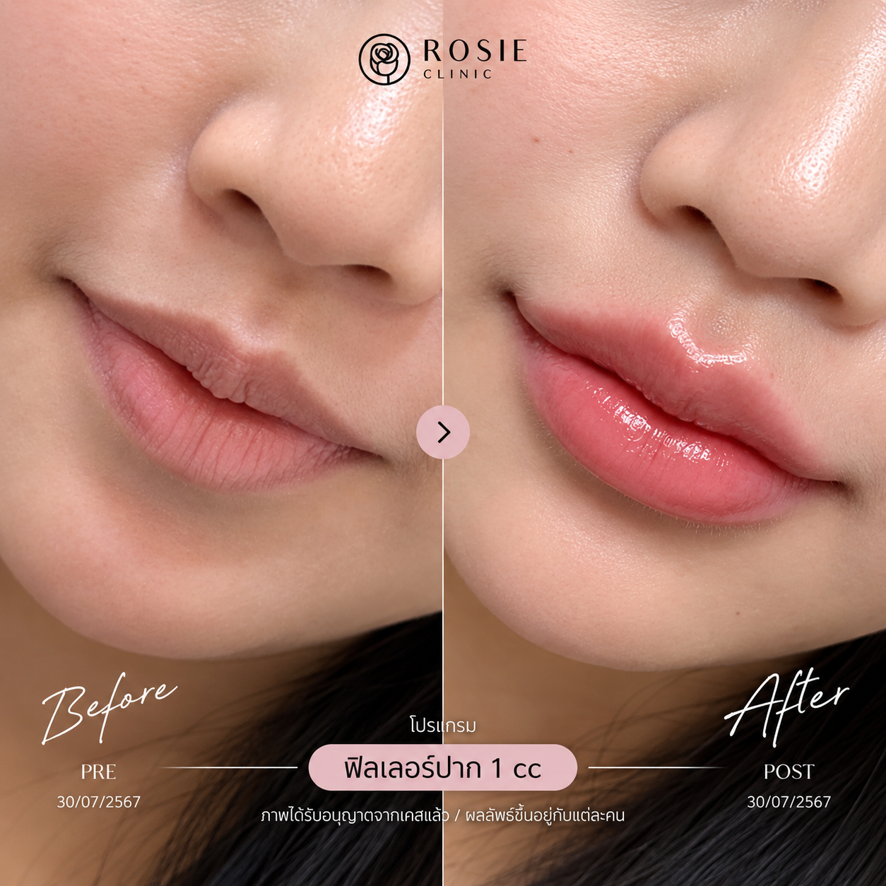 รีวิวโปรแกรมฟิลเลอร์ปาก ก่อนและหลัง ภาพที่ 5