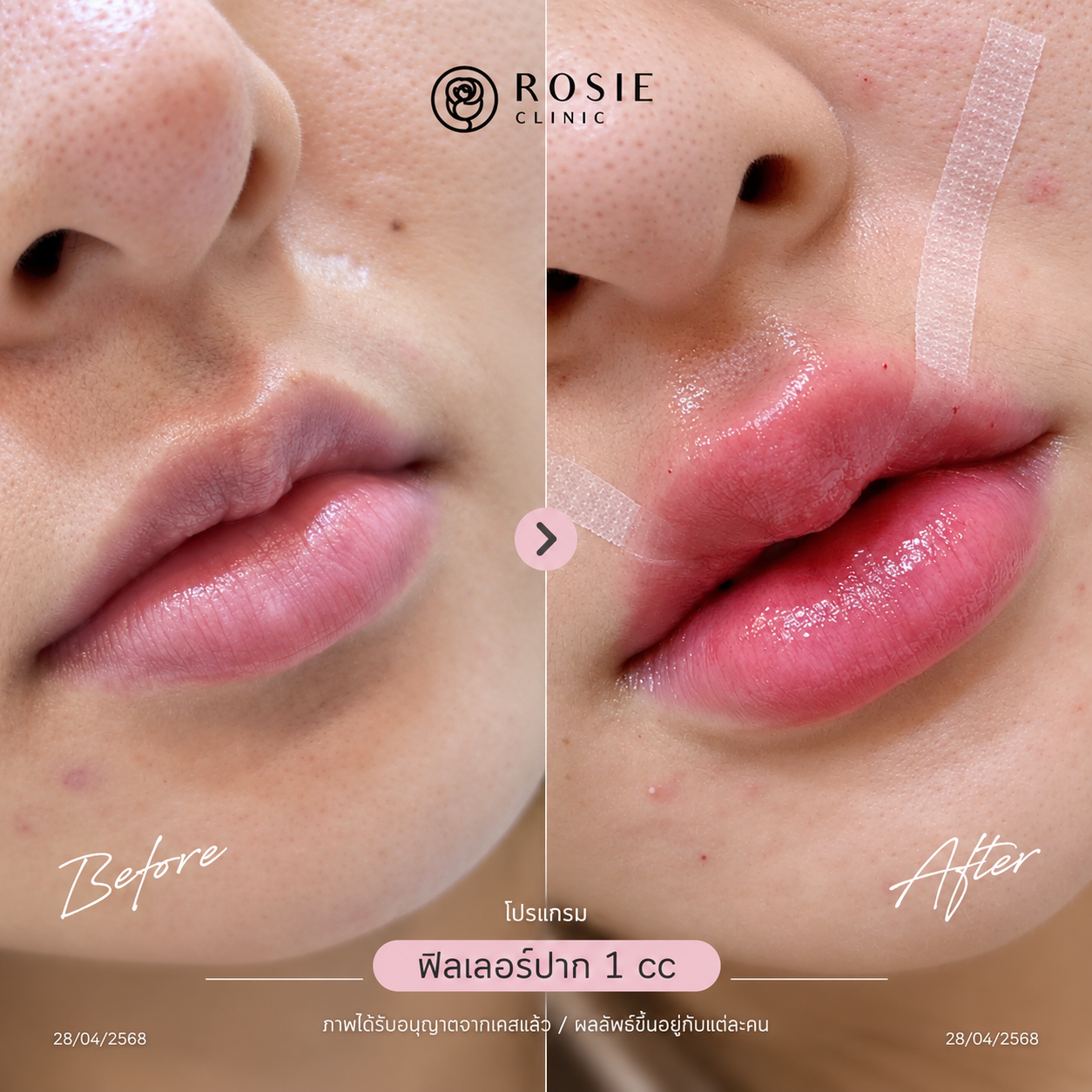 รีวิวโปรแกรมฟิลเลอร์ปาก ก่อนและหลัง ภาพที่ 6