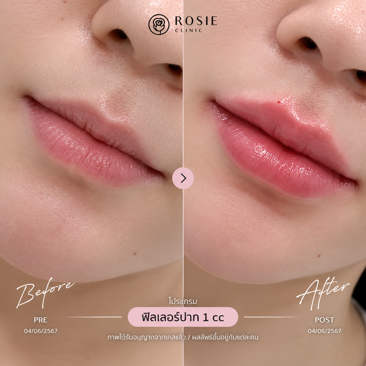 รีวิวโปรแกรมฟิลเลอร์ปาก ก่อนและหลัง ภาพที่ 7
