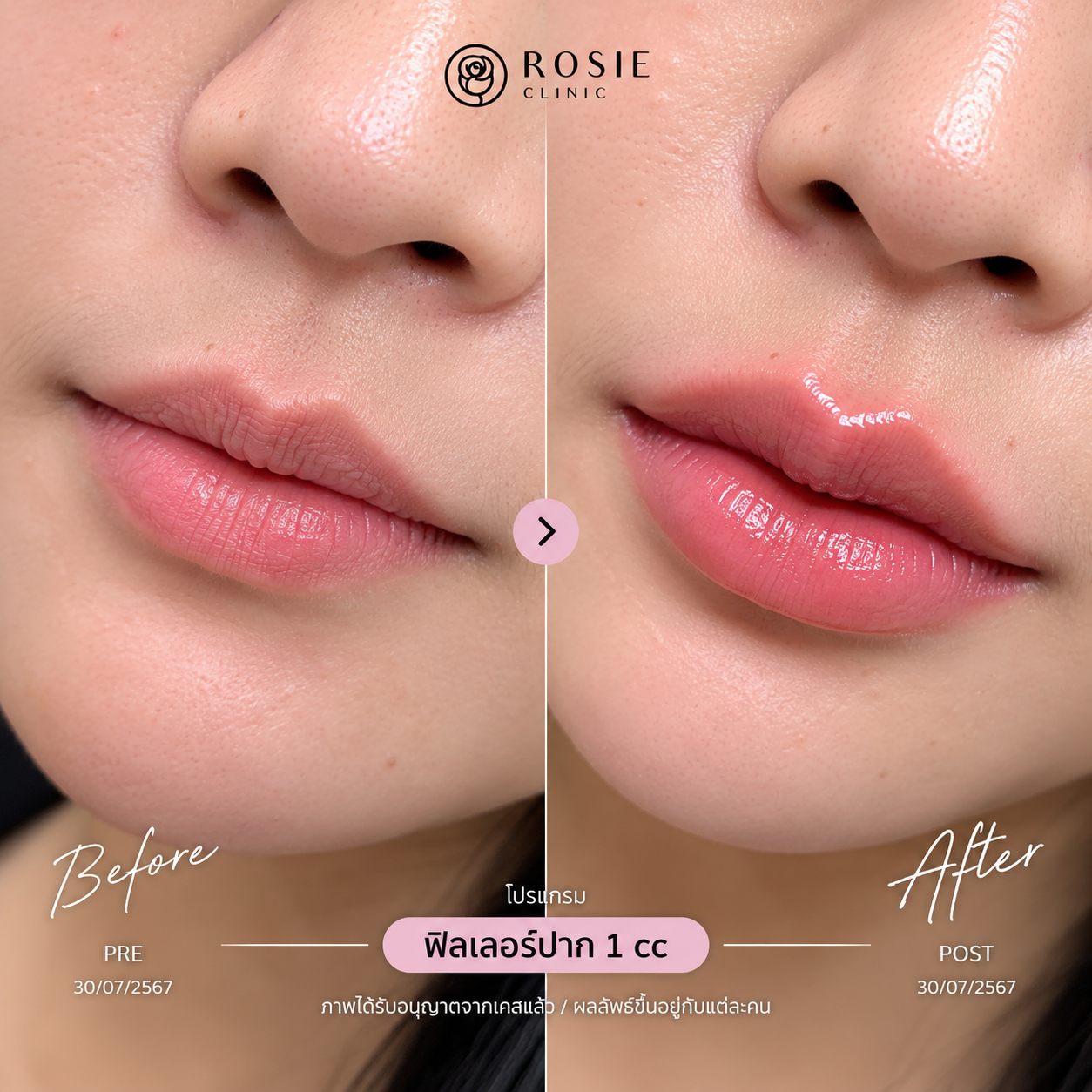 รีวิวโปรแกรมฟิลเลอร์ปาก ก่อนและหลัง ภาพที่ 8