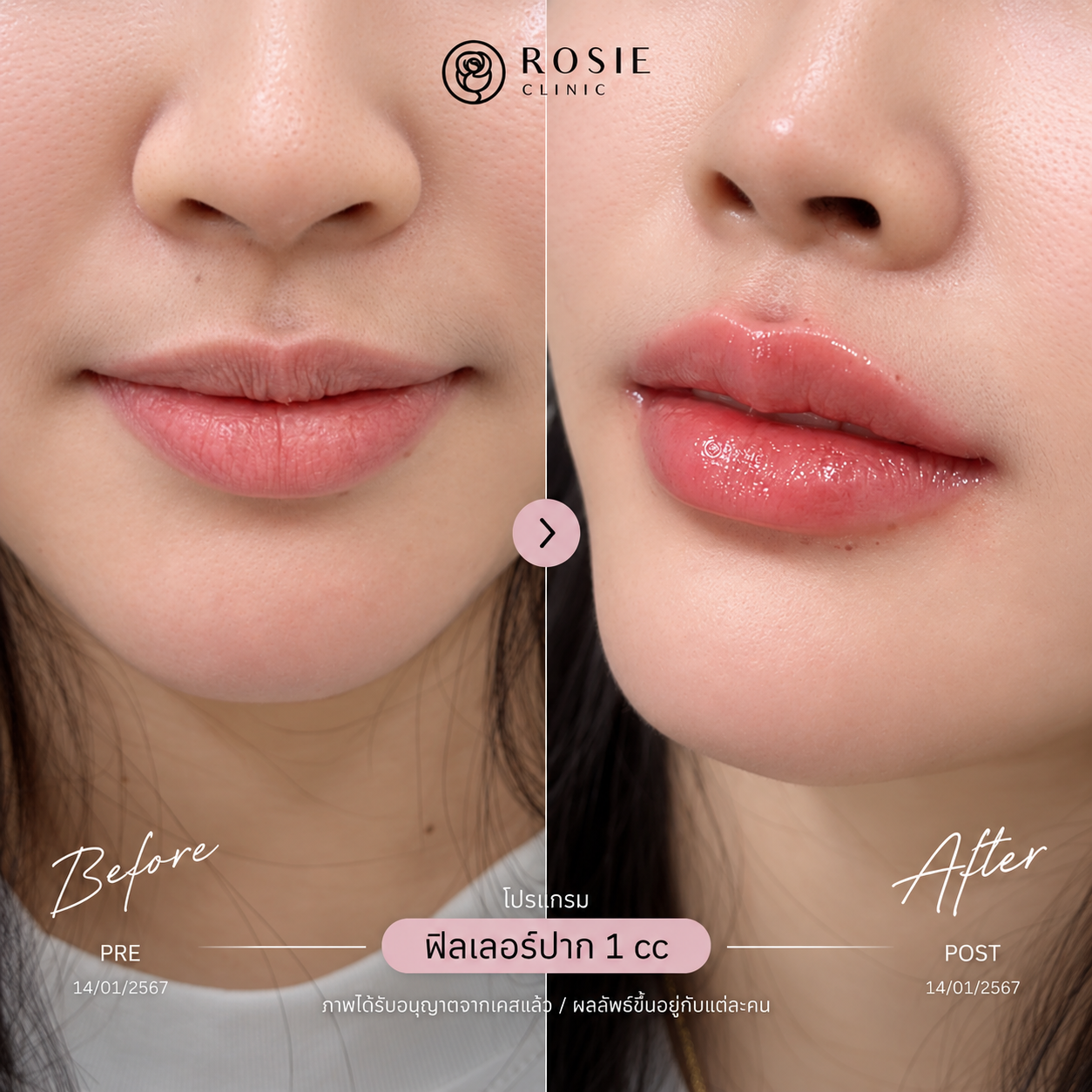 รีวิวโปรแกรมฟิลเลอร์ปาก ก่อนและหลัง ภาพที่ 9