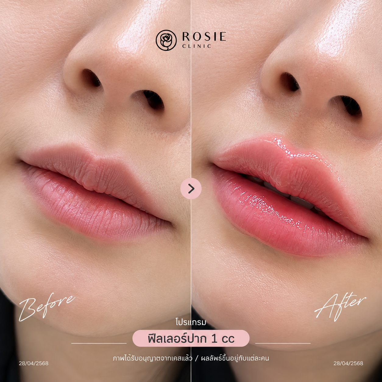 รีวิวโปรแกรมฟิลเลอร์ปาก ก่อนและหลัง ภาพที่ 10