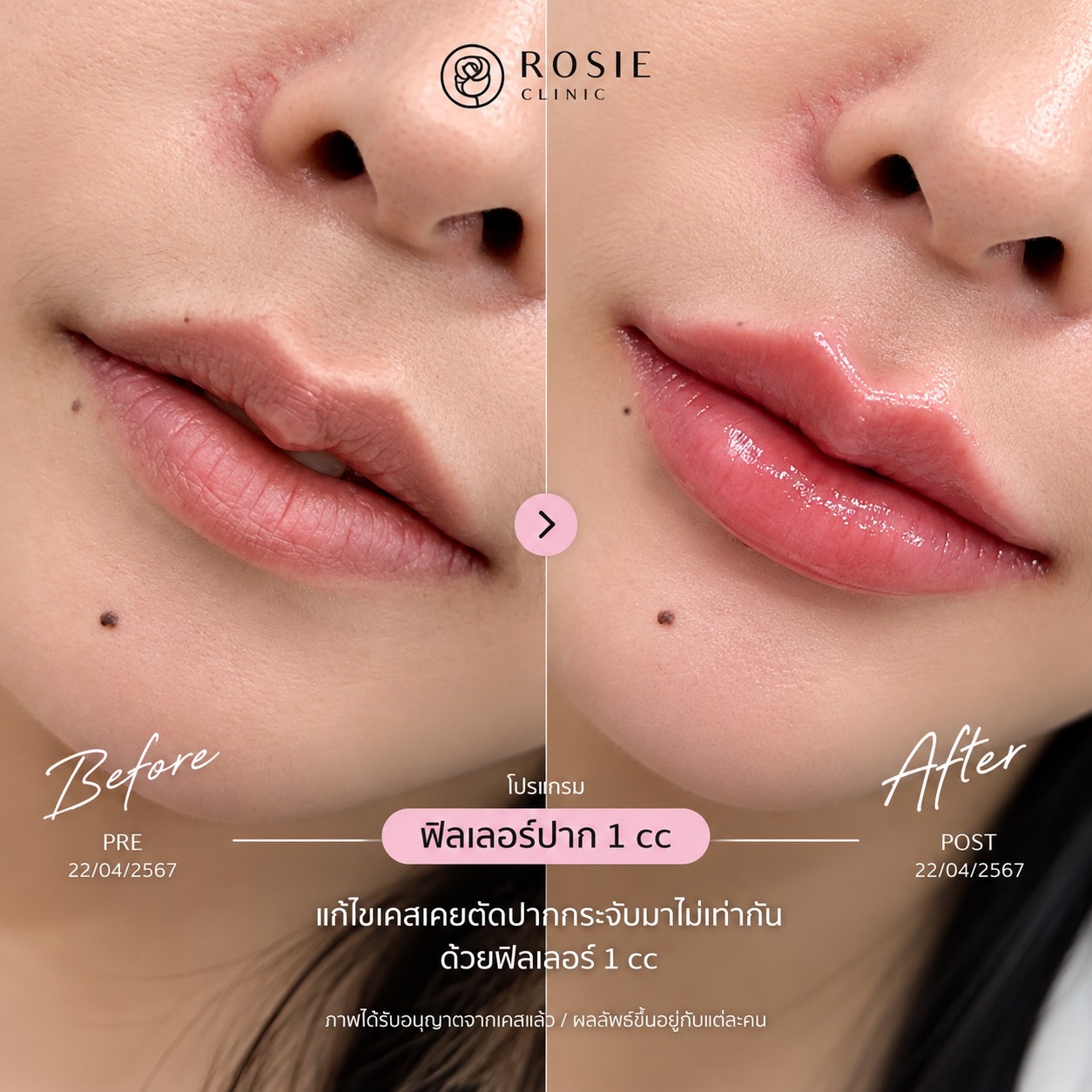 รีวิวโปรแกรมฟิลเลอร์ปาก ก่อนและหลัง ภาพที่ 11