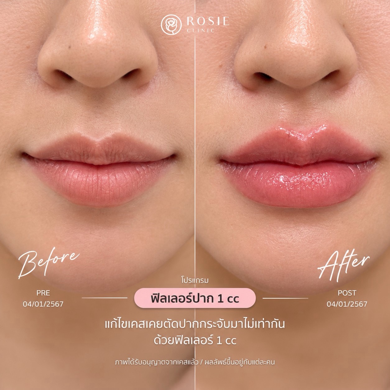 รีวิวโปรแกรมฟิลเลอร์ปาก ก่อนและหลัง ภาพที่ 12