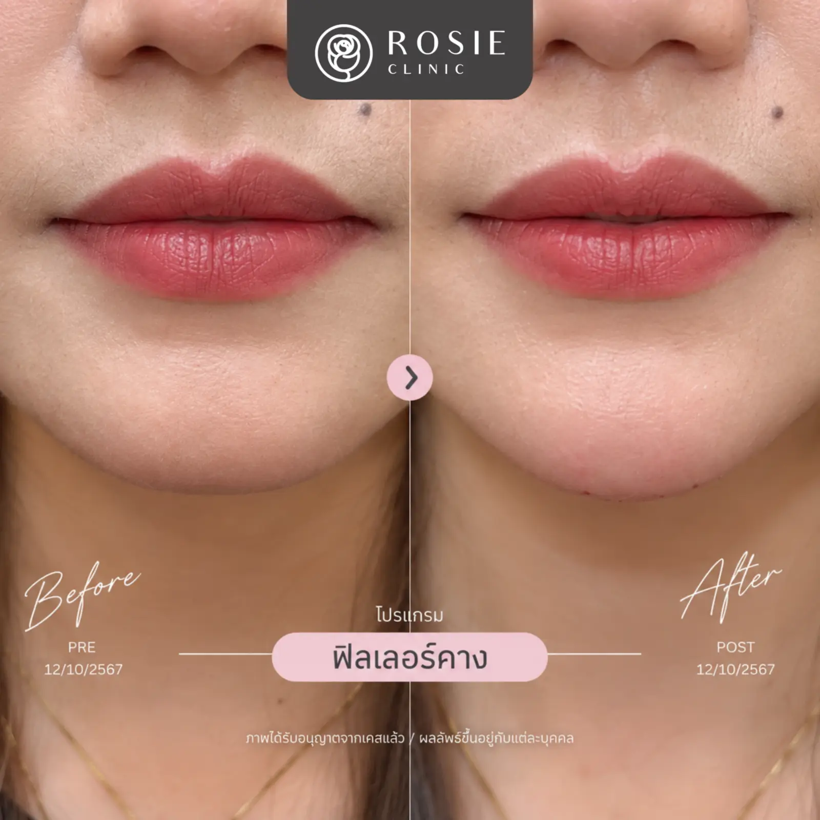 รีวิวฟิลเลอร์คาง