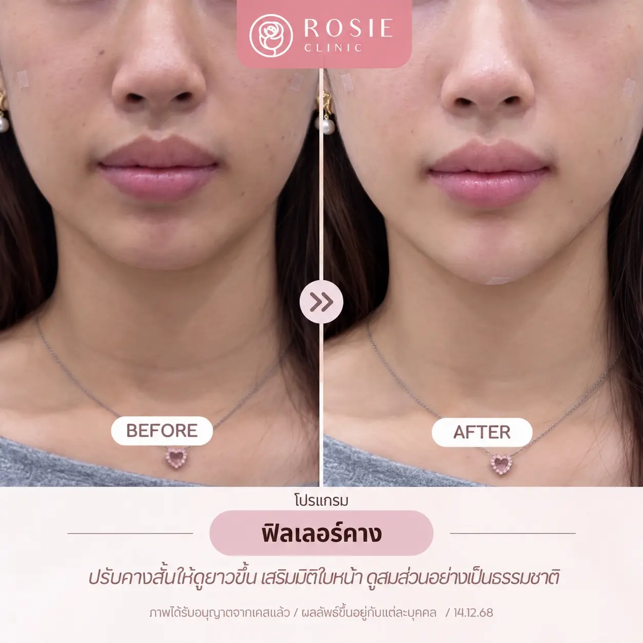 รีวิวฟิลเลอร์คาง ภาพที่ 2