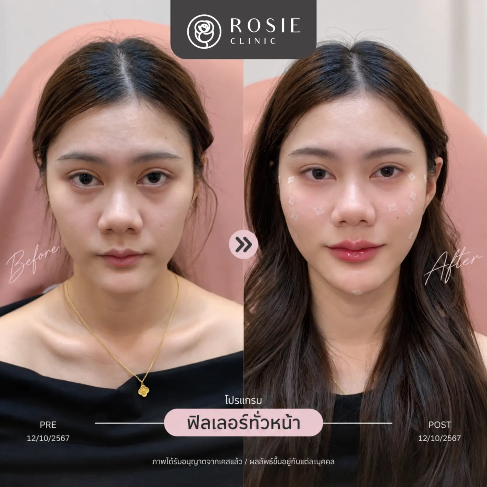 รีวิวปรับรูปหน้า ภาพที่ 1