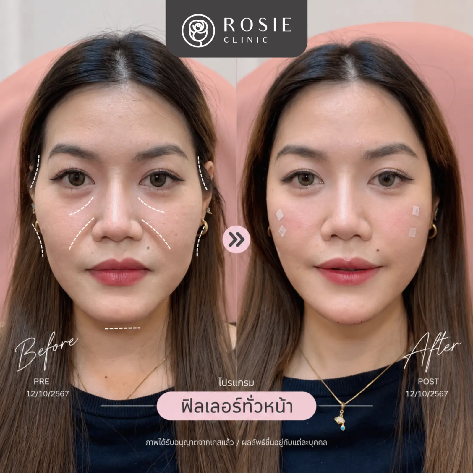 รีวิวปรับรูปหน้า ภาพที่ 2