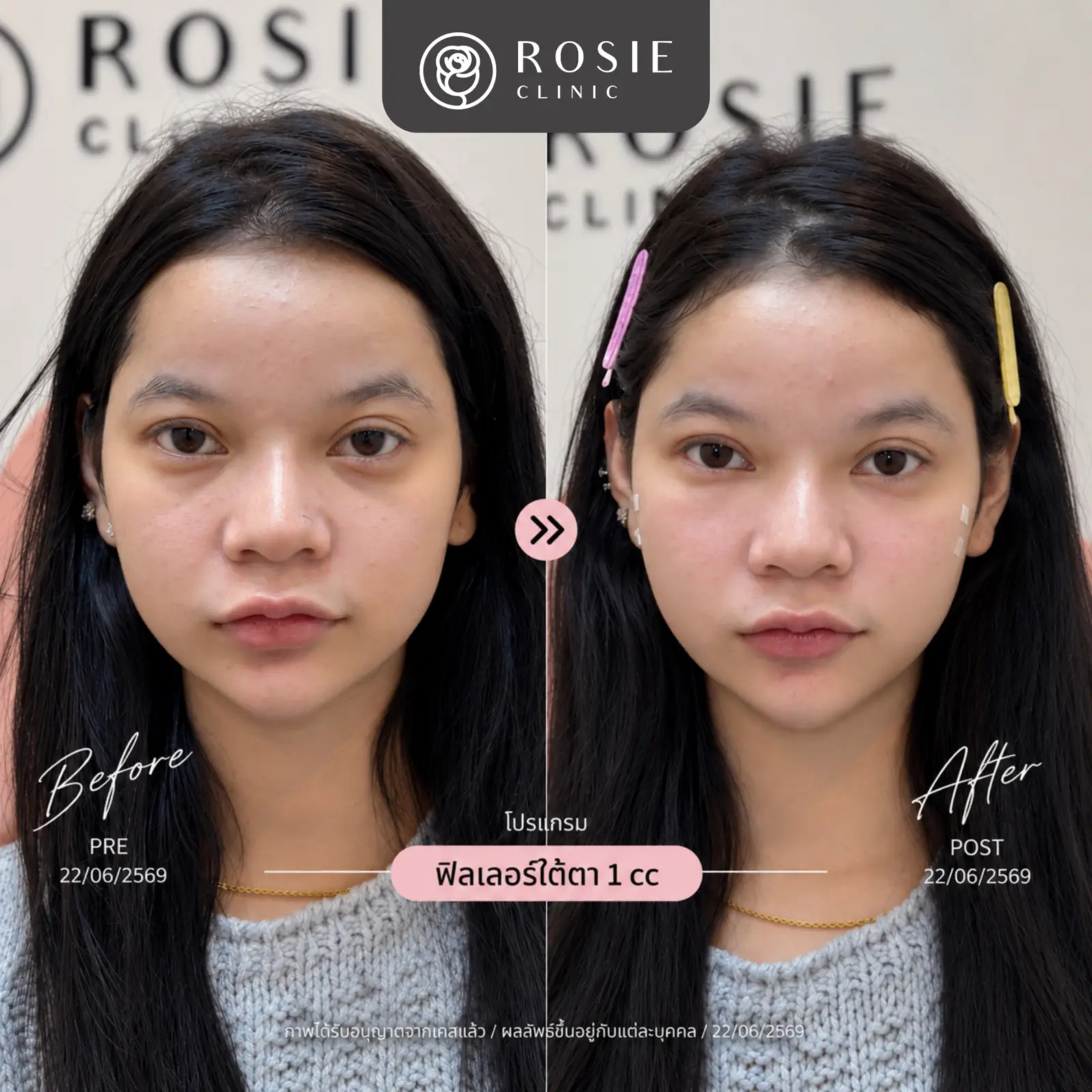 รีวิวปรับรูปหน้า ภาพที่ 3