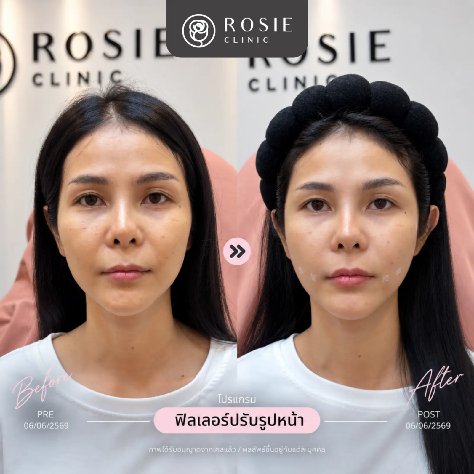 รีวิวปรับรูปหน้า ภาพที่ 5