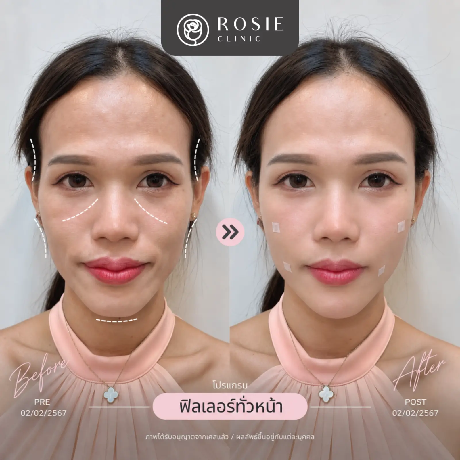 รีวิวปรับรูปหน้า ภาพที่ 6