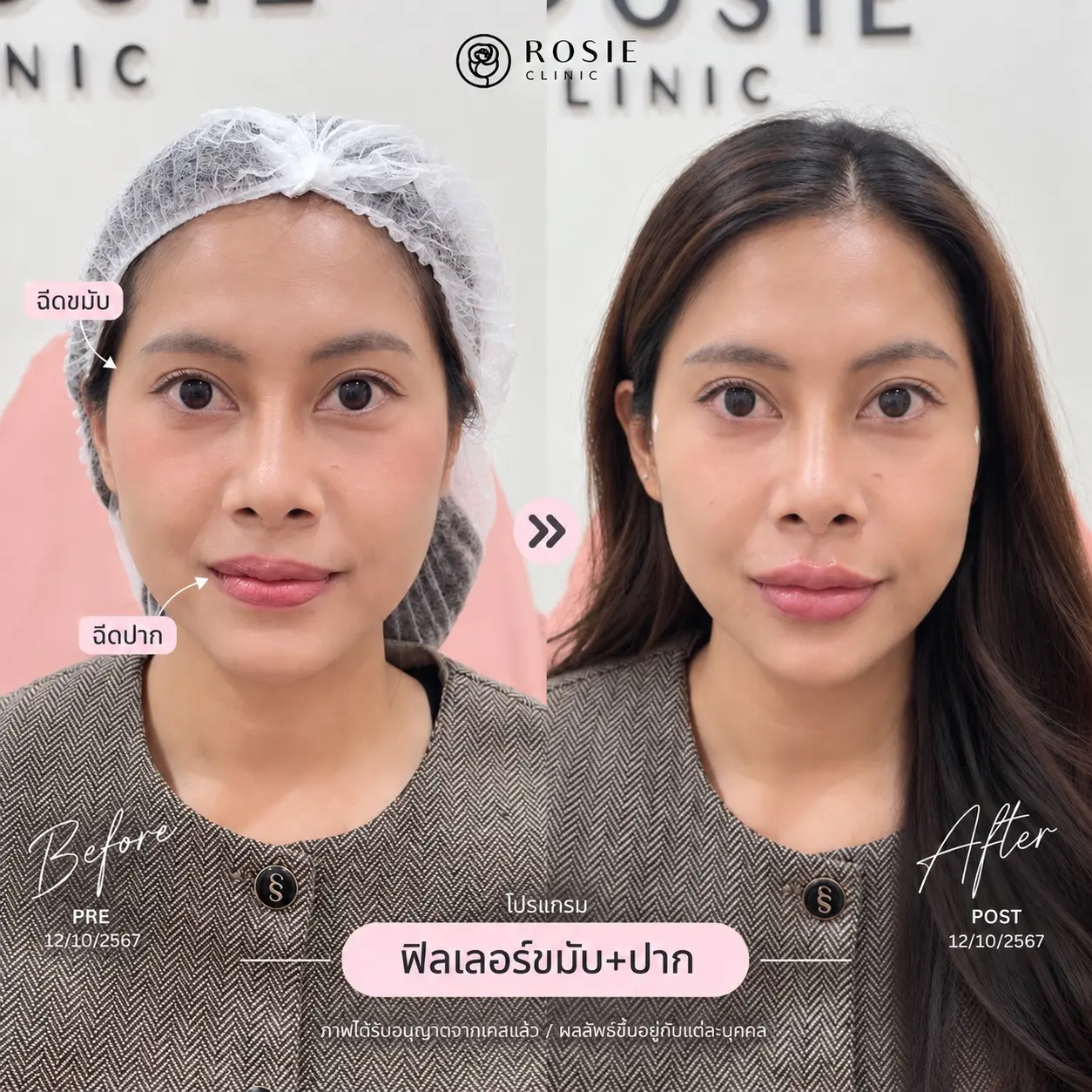 รีวิวปรับรูปหน้า ภาพที่ 7