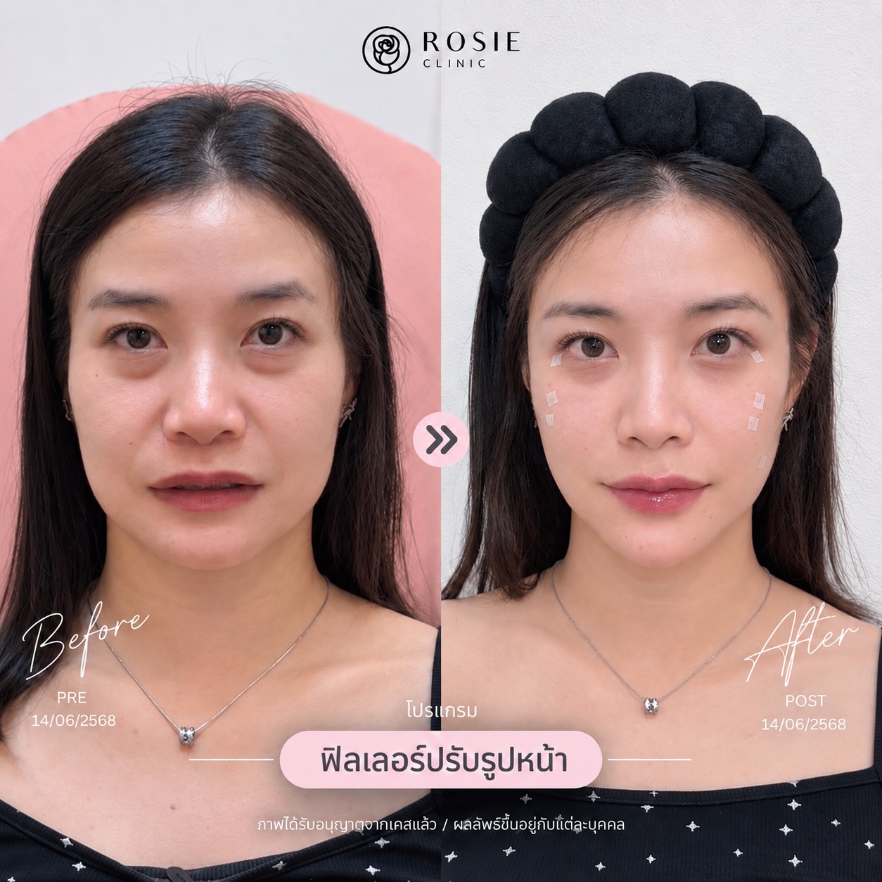 รีวิวปรับรูปหน้า ภาพที่ 8