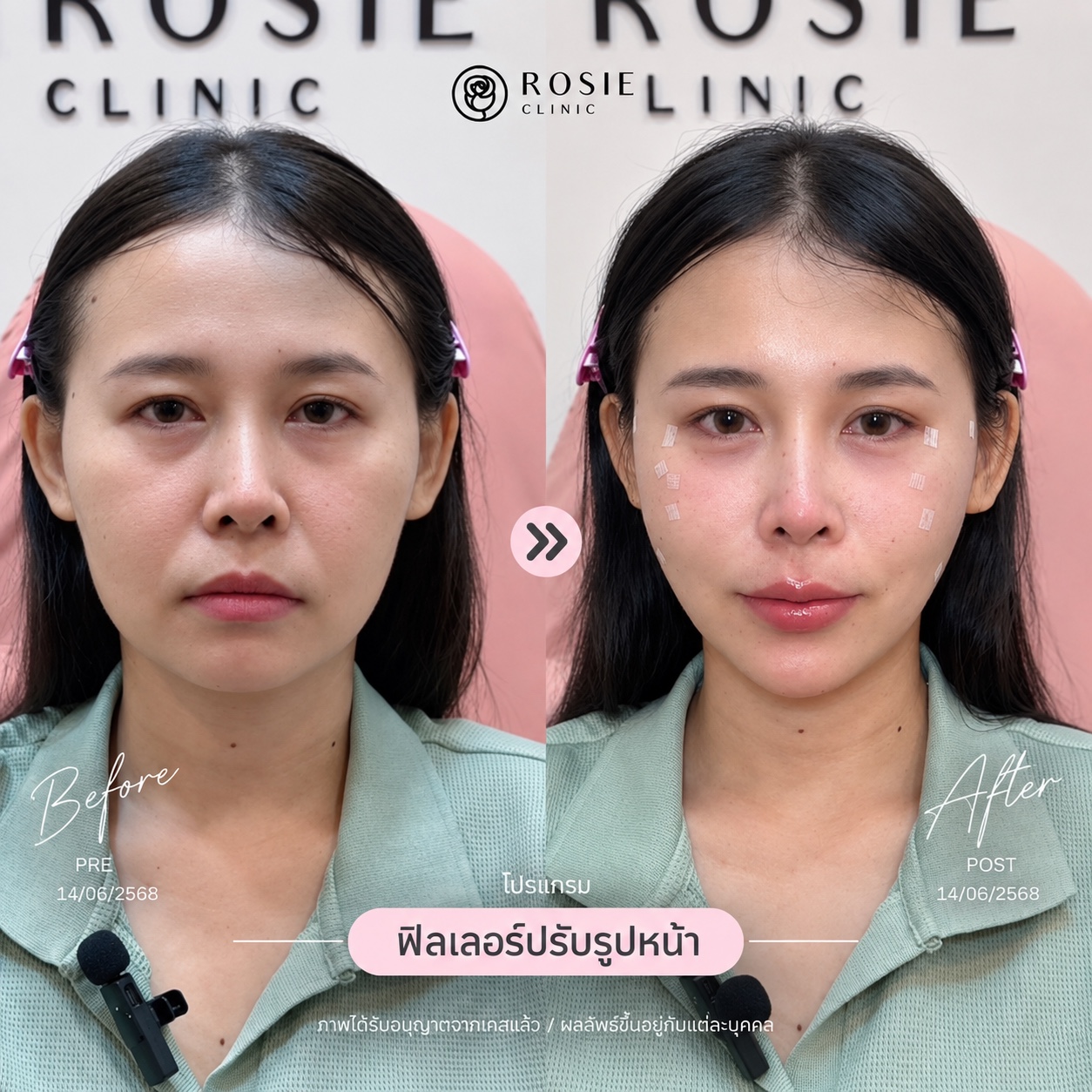 รีวิวปรับรูปหน้า ภาพที่ 9