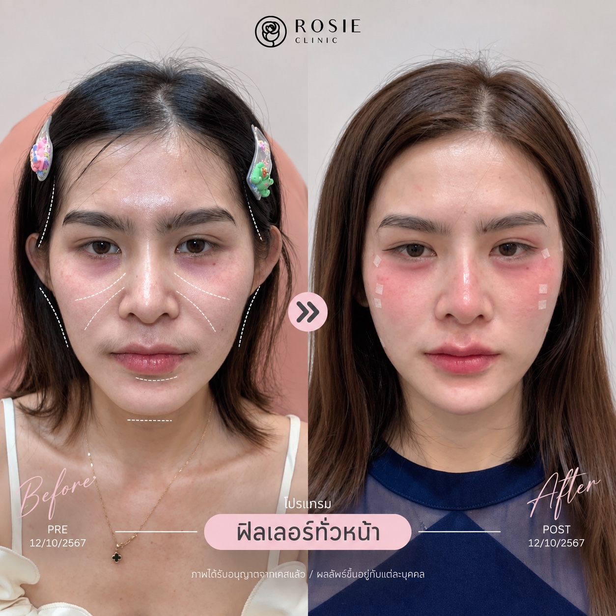 รีวิวปรับรูปหน้า ภาพที่ 10