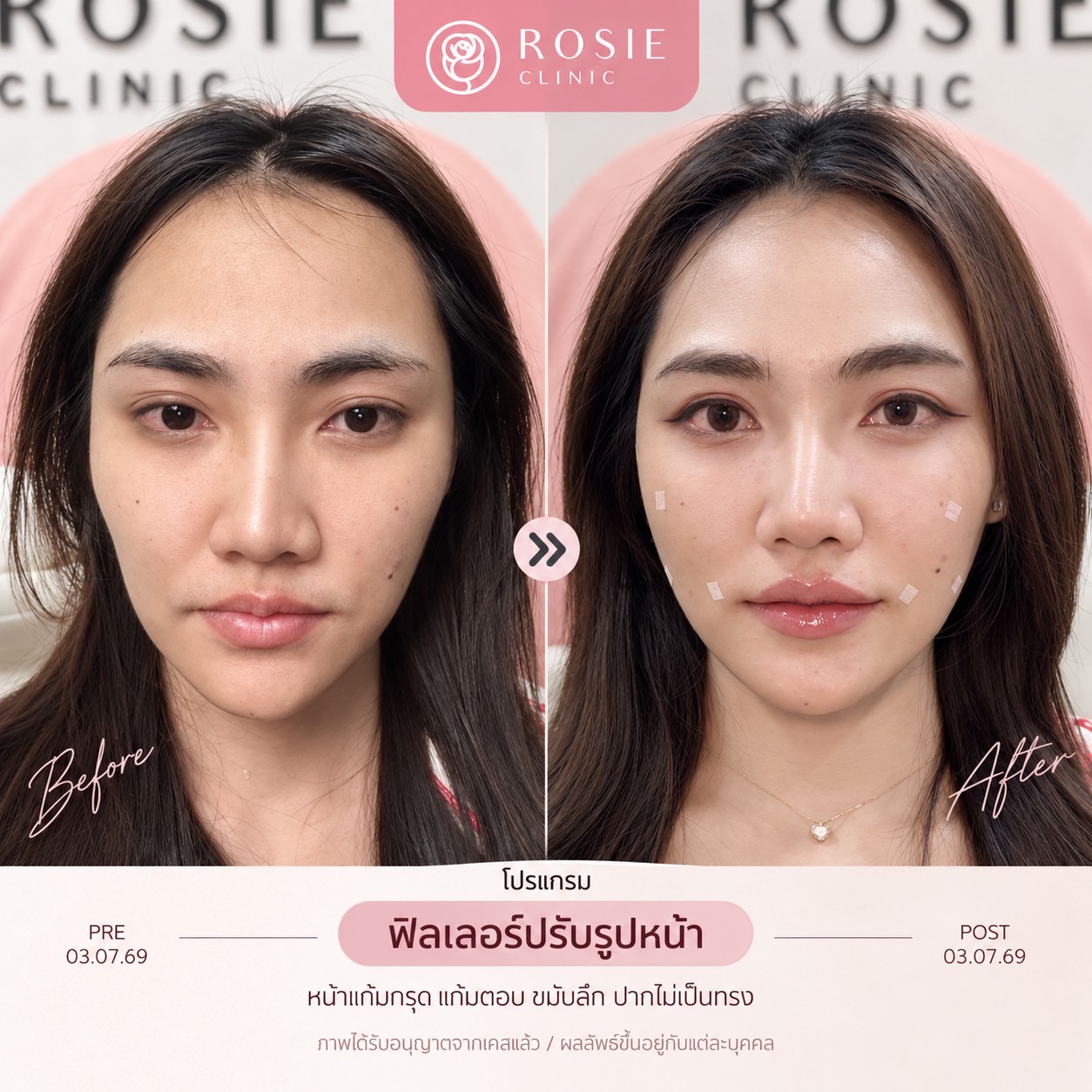 รีวิวปรับรูปหน้า ภาพที่ 11