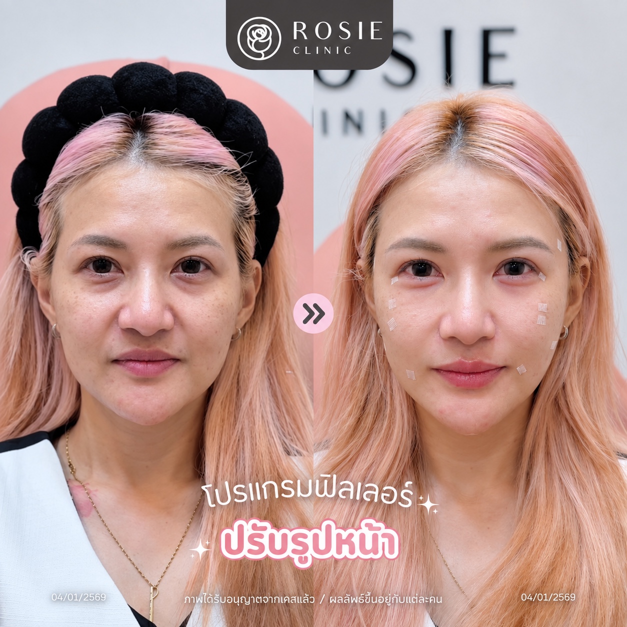 รีวิวปรับรูปหน้า ภาพที่ 12