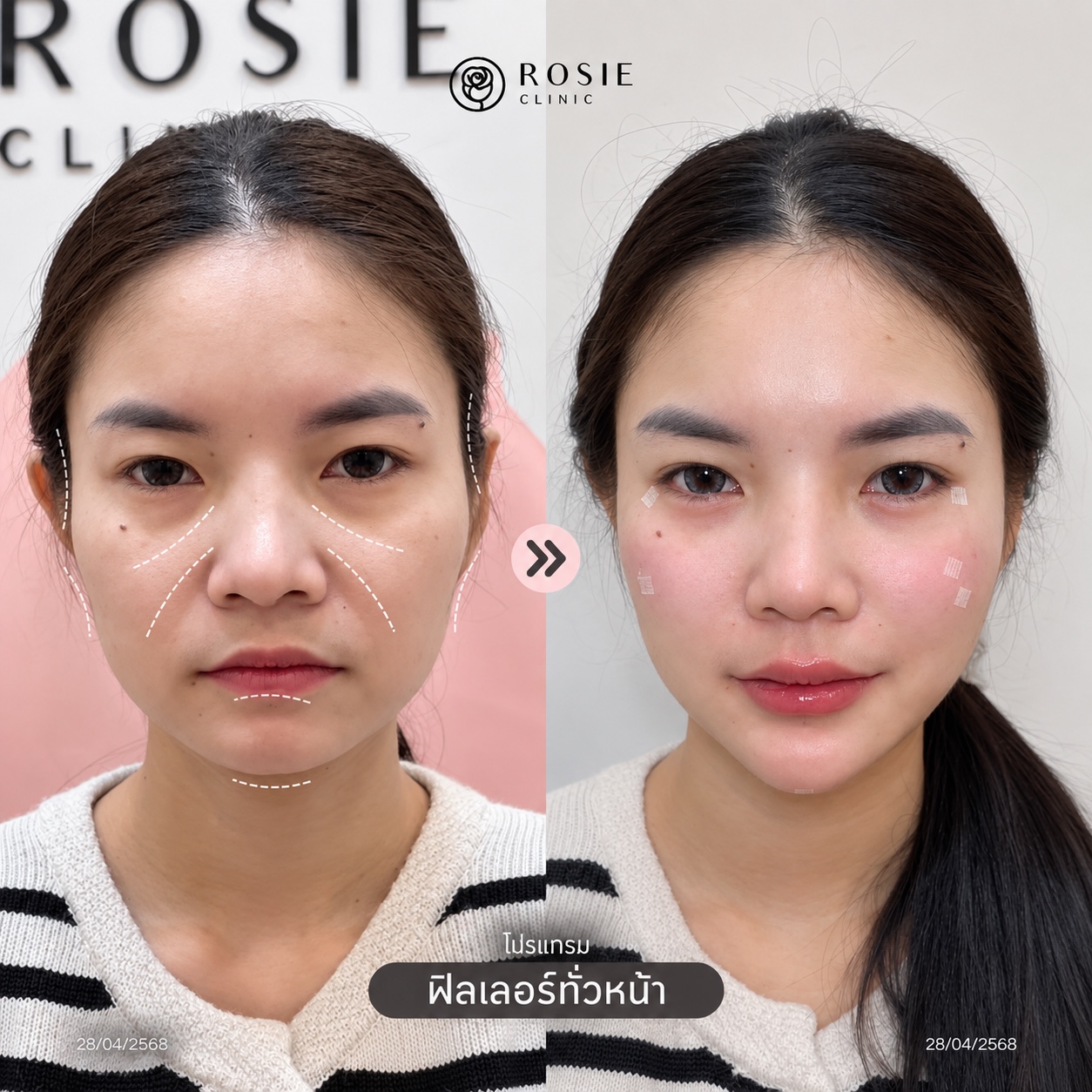 รีวิวปรับรูปหน้า ภาพที่ 13