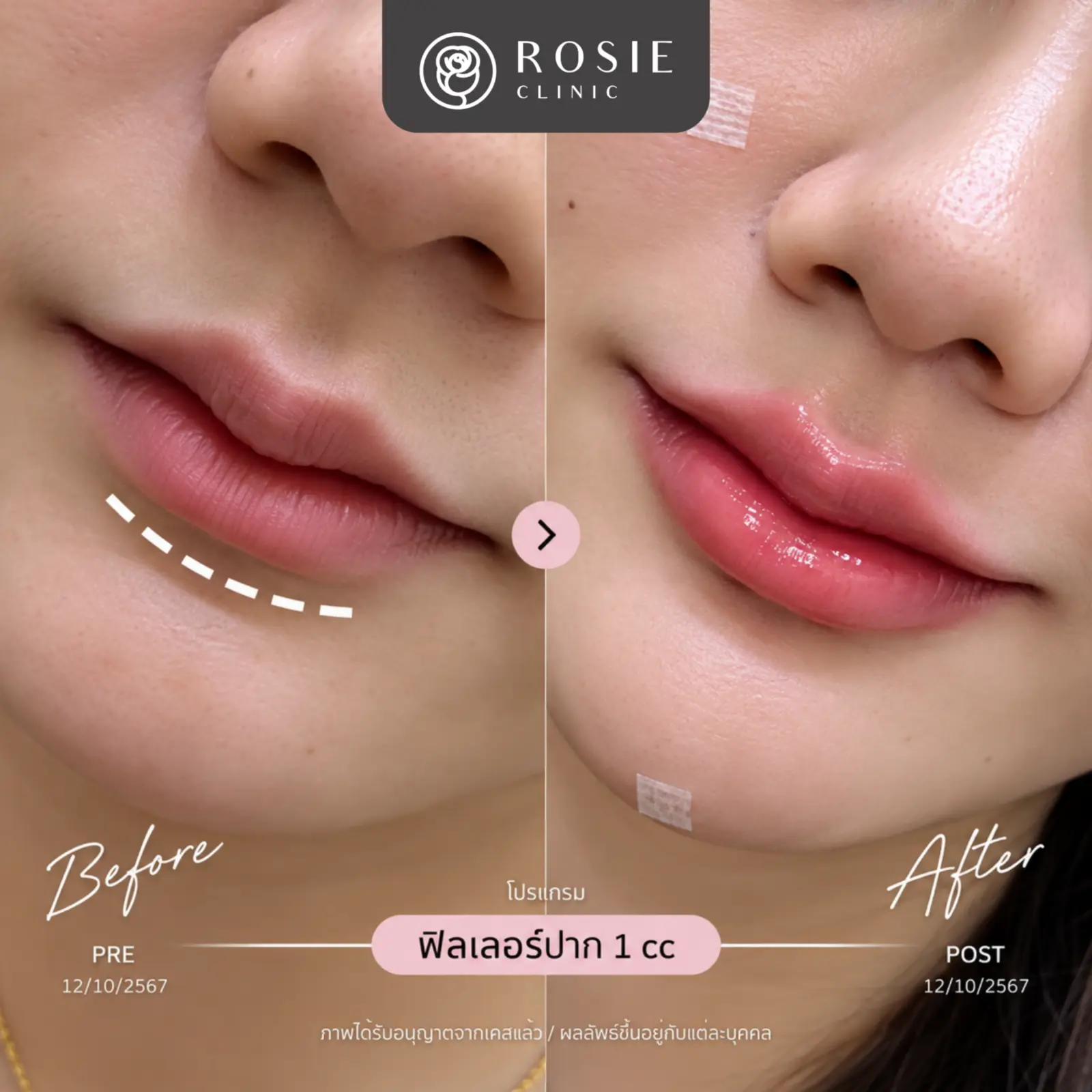 รีวิวโปรแกรมฟิลเลอร์ปาก ก่อนและหลัง ภาพที่ 13