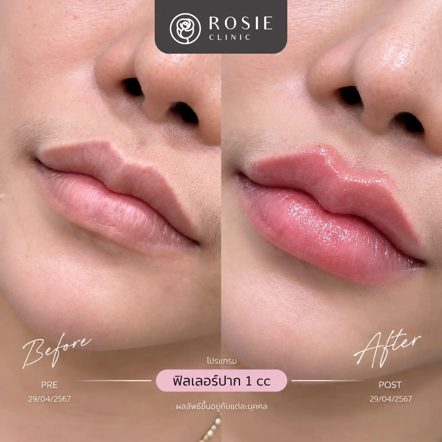 รีวิวโปรแกรมฟิลเลอร์ปาก ก่อนและหลัง ภาพที่ 14