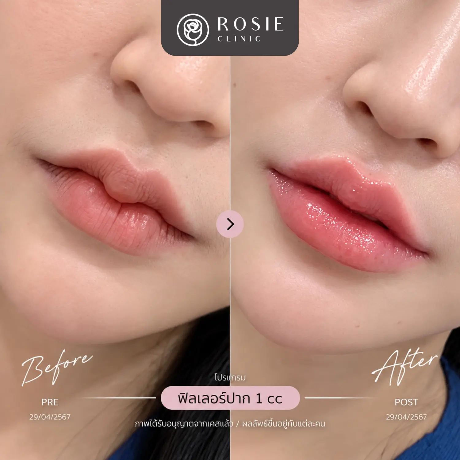 รีวิวโปรแกรมฟิลเลอร์ปาก ก่อนและหลัง ภาพที่ 15
