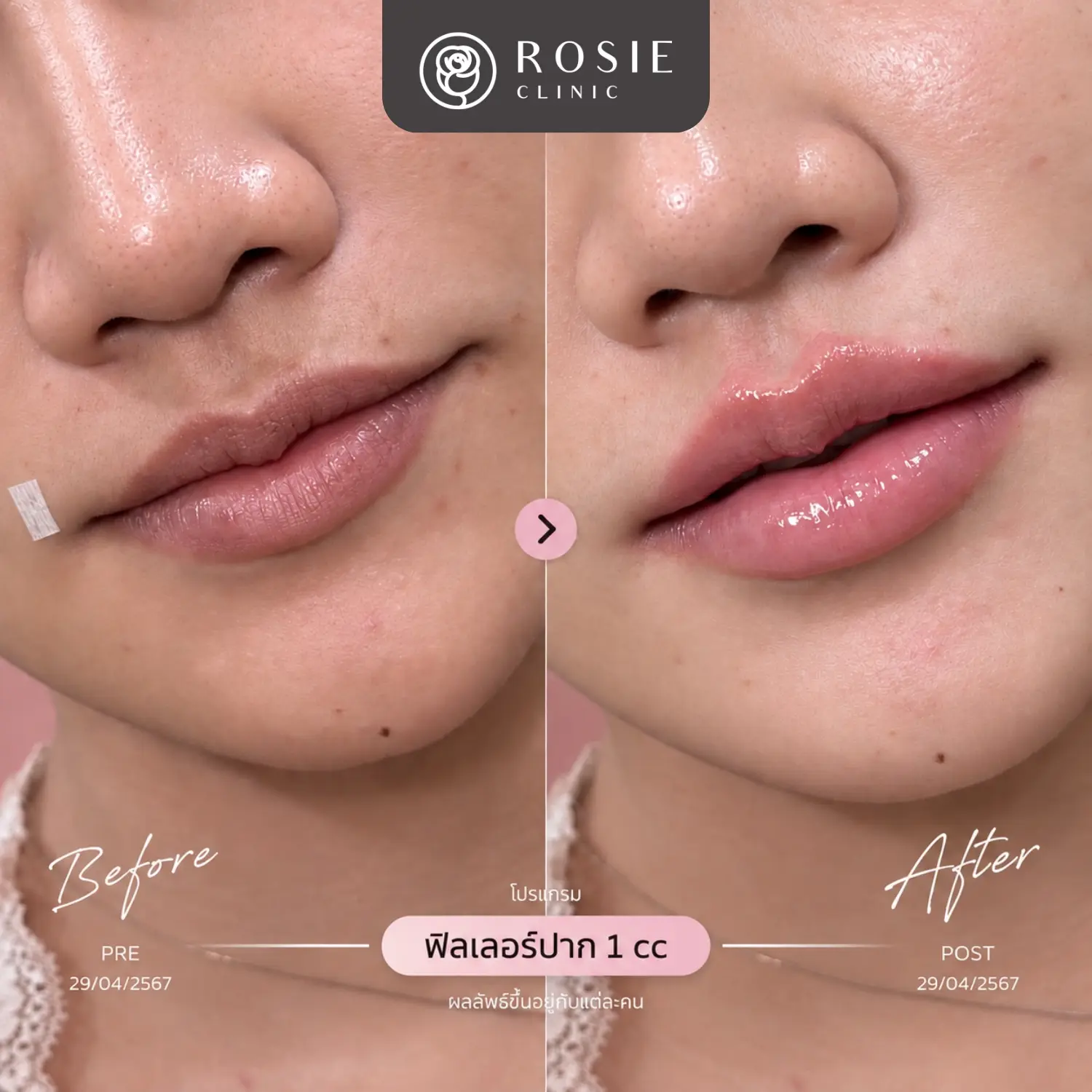 รีวิวโปรแกรมฟิลเลอร์ปาก ก่อนและหลัง ภาพที่ 16
