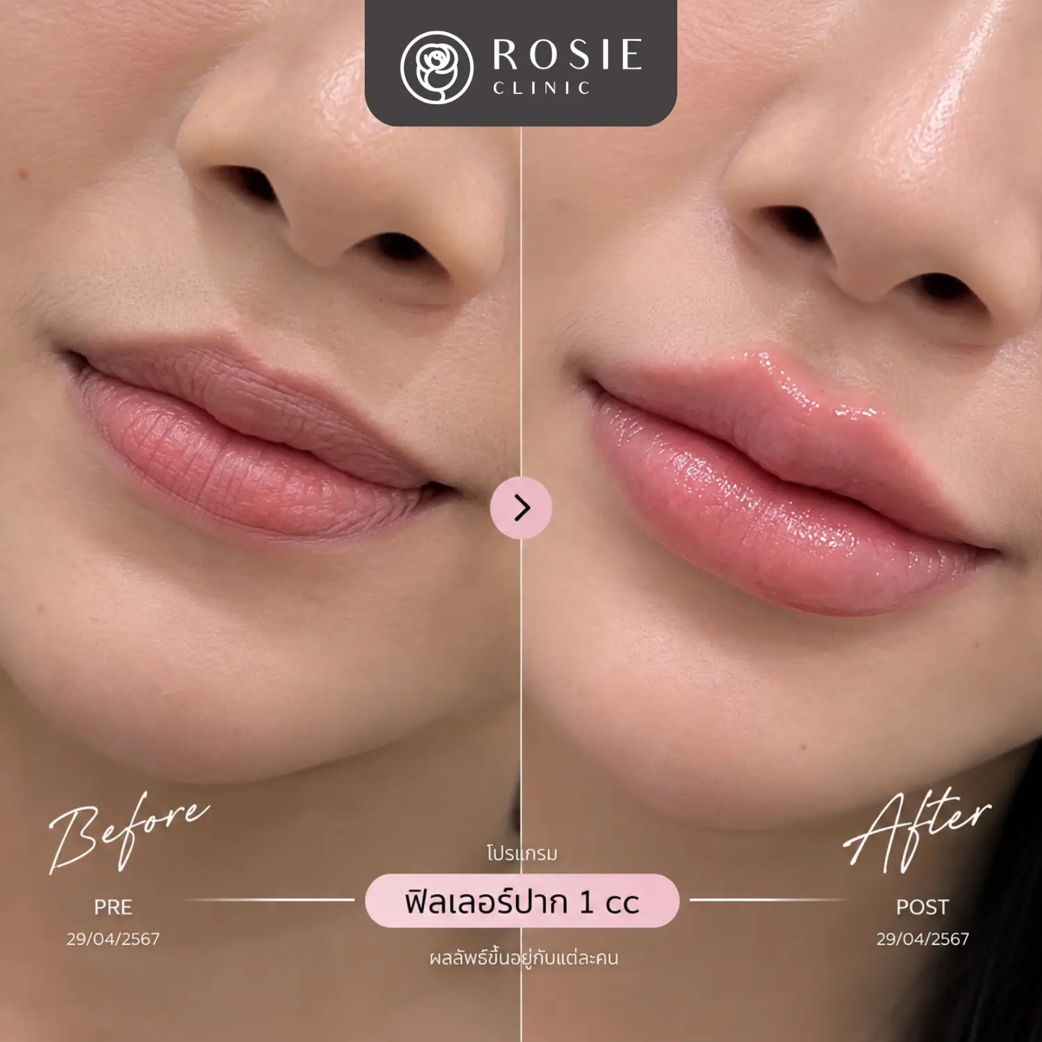 รีวิวโปรแกรมฟิลเลอร์ปาก ก่อนและหลัง ภาพที่ 17
